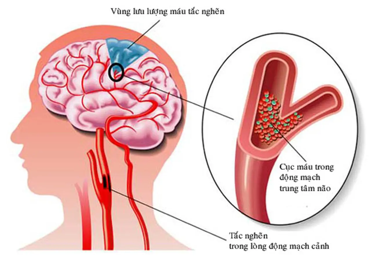 Điều trị rối loạn tuần hoàn