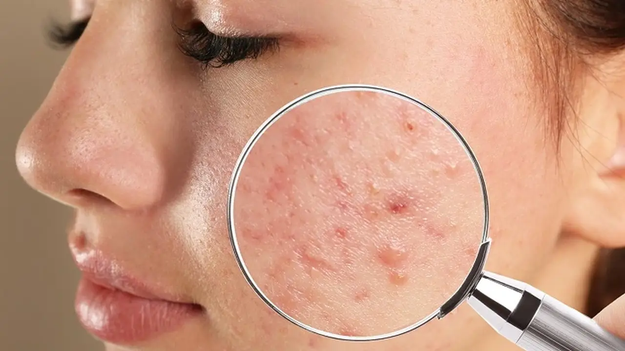 Điều trị mụn